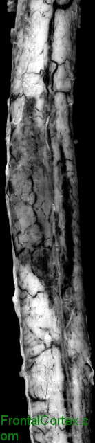 Intramedullary spinal cord hemorrhage, gross photograph of ventral surface of spinal cord